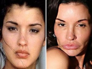 janice-dickinson-before-after-plastic-surgery